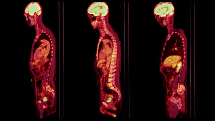 A PET-CT scan image is a diagnostic visualization combining Positron Emission Tomography (PET) and Computed Tomography (CT) for Helps in finding cancer recurrence.