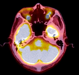 A PET-CT scan image is a diagnostic visualization combining Positron Emission Tomography (PET) and Computed Tomography (CT) for Helps in finding cancer recurrence.