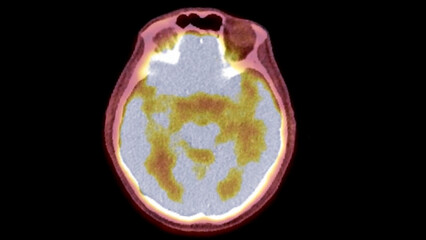A PET-CT scan image is a diagnostic visualization combining Positron Emission Tomography (PET) and Computed Tomography (CT) for Helps in finding cancer recurrence.