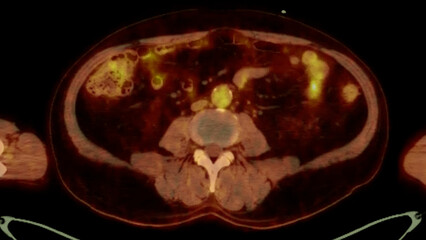 A PET-CT scan image is a diagnostic visualization combining Positron Emission Tomography (PET) and Computed Tomography (CT) for Helps in finding cancer recurrence.