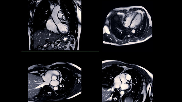 Cardiac MRI images are instrumental in assessing cardiac health, identifying heart abnormalities, and guiding treatment plans.