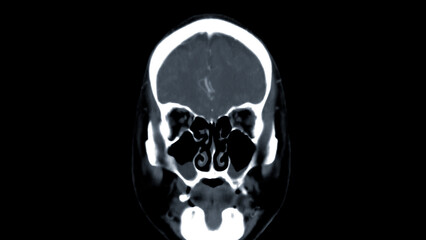 CT scan of the brain Coronal view  for diagnosis brain tumor,stroke diseases and vascular diseases.