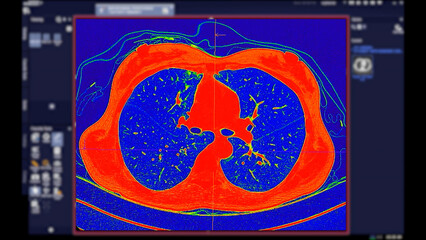 CT scan of Chest Axial view in color mode  for diagnostic Pulmonary embolism (PE) , lung cancer and covid-19.