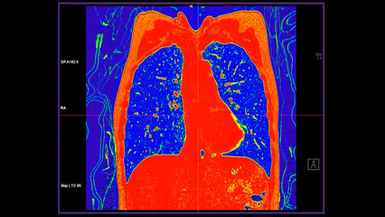 CT scan of Chest coronal view in color mode  for diagnostic Pulmonary embolism (PE) , lung cancer and covid-19.