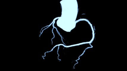 CTA coronary artery 3D rendering is a diagnostic imaging technique capturing detailed visuals of the heart's blood vessels in diagnosing coronary artery diseases and assessing cardiac health.