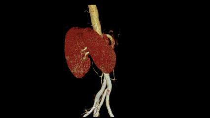 CTA Renal artery 3D is a medical imaging procedure using CT scans to examine the renal arteries It provides detailed images of the blood vessels supplying the kidneys.
