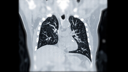 CTPA or CTA pulmonary artery .This imaging technique offers a clear view of the pulmonary arteries, aiding in the diagnosis of pulmonary embolism, vascular conditions, and other respiratory issues. - obrazy, fototapety, plakaty