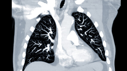 CTPA or CTA pulmonary artery .This imaging technique offers a clear view of the pulmonary arteries, aiding in the diagnosis of pulmonary embolism, vascular conditions, and other respiratory issues.