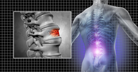 Spinal Fracture and lower back pain as a spine injury and vertebral trauma as an Osteopathic medical concept.
