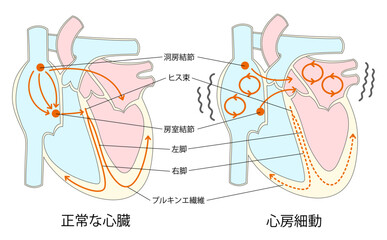 正常な心臓と心房細動の比較イラスト