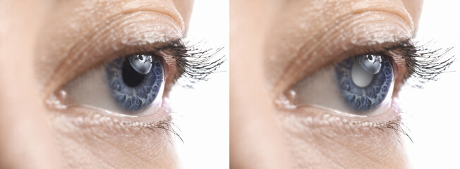 Closeup view of woman before and after glaucoma treatment on white background, closeup