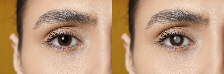 Closeup view of woman before and after glaucoma treatment on yellow background, closeup