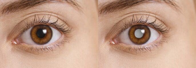 Naklejka premium Closeup view of woman before and after glaucoma treatment, closeup