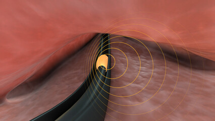 Brachytherapy for cervical cancer or intracavitary brachytherapy