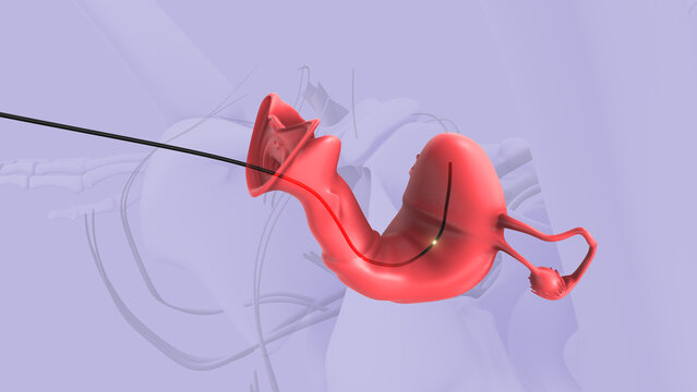 Brachytherapy for cervical cancer or intracavitary brachytherapy