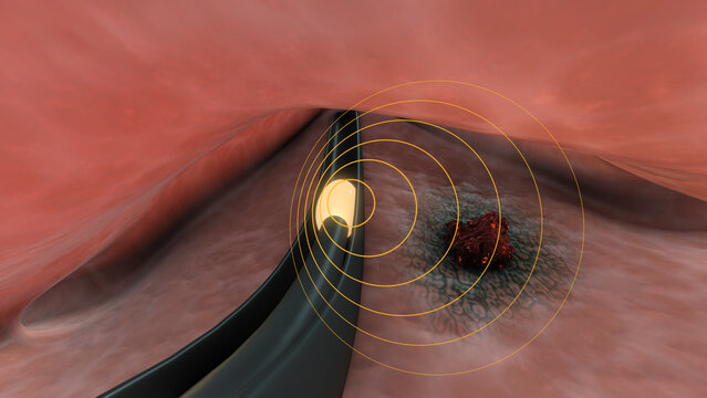 Brachytherapy for cervical cancer or intracavitary brachytherapy