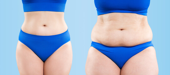 Woman's belly before and after liposuction and weight loss on blue background, plastic surgery...
