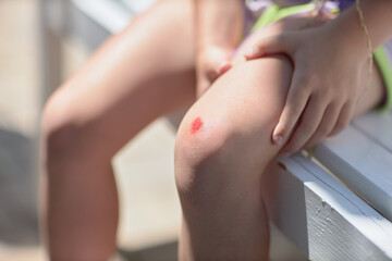 Wounded knee of the child. Abrasion on the lap of baby close-up after the fall. A scratch with...