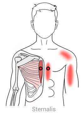 Sternalis: Myofascial trigger points and associated pain locations