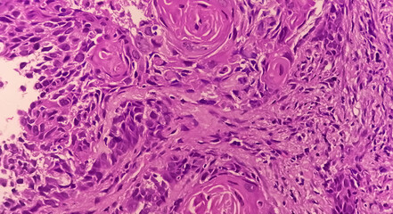 Invasive squamous cell carcinoma of larynx grade 2