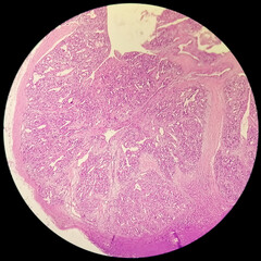 Photomicrograph of histological slide showing Lobular capillary hemangioma on finger.