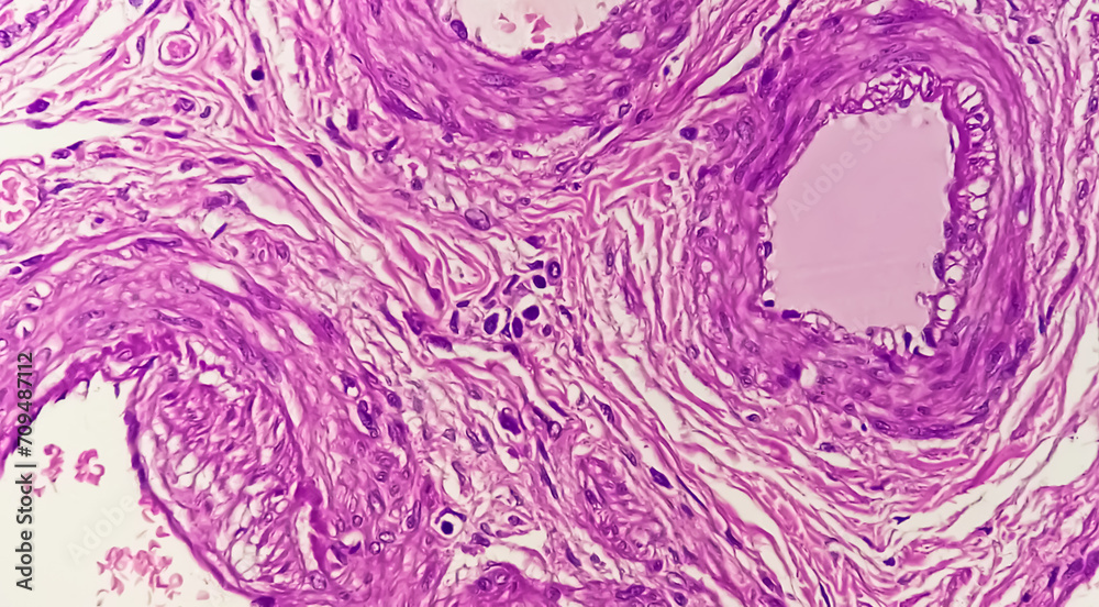 Poster Histopathological photomicrograph of ovarian cyst showing Metastatic cystic teratoma.