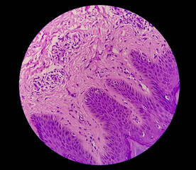 Histological Photomicrograph: Prurigo nodularis (PN) is a chronic disorder of the skin. 