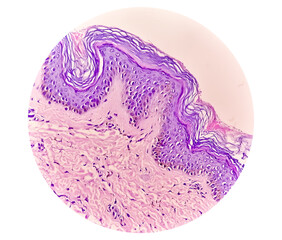 Histological Photomicrograph: Prurigo nodularis (PN) is a chronic disorder of the skin. 