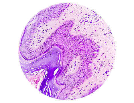Histological Photomicrograph: Prurigo nodularis (PN) is a chronic disorder of the skin. 
