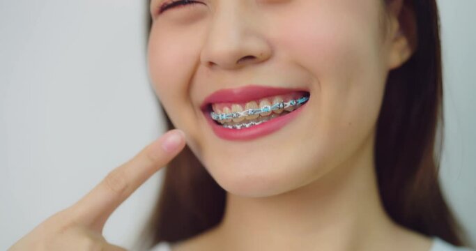 Happy beautiful asian girl with braces. Close-up into her mouth and smiling at white background.