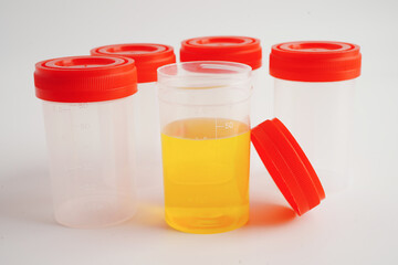 Urinalysis, urine cup for check health examination in laboratory.