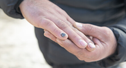 Human showing broken nail in hand.