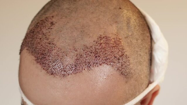 the top of a man's head right after a hair transplant by the FUE method. New 1500 hairs are added, the transplanted area is still covered in scabs, and the forehead is swollen.
