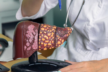 Close up of model of a human liver with the words normal, fibrotic, cirrhotic, cancerous. a female doctor shows the patient a stage 4 liver: normal, fibrous, cirrhotic, malignant. The liver means your