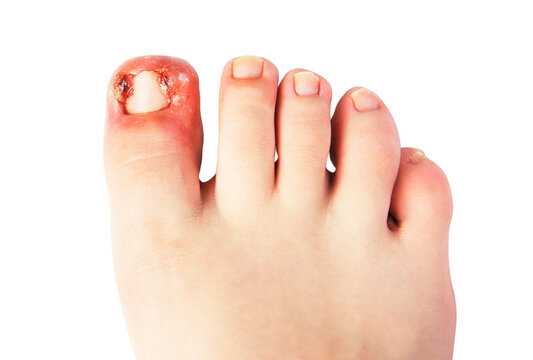 Child foot: onychocryptosis - an ingrown toenail