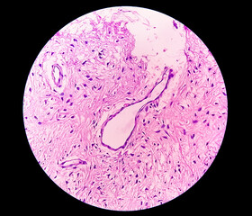 Leg tissue biopsy: Photomicrographic image showing Fibromyxoma. Superficial Acral Fibromyxoma, rare...