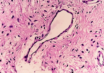 Leg tissue biopsy: Photomicrographic image showing Fibromyxoma. Superficial Acral Fibromyxoma, rare...