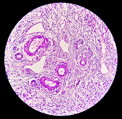 Histology, Peritoneal inclusion cyst. Paraovarian cysts, hydrosalpinx and low-grade cystic mesothelioma are usually considered in the differential diagnosis of PICs.