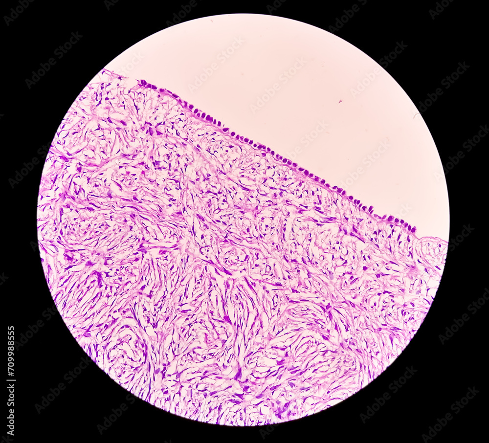 Poster Histology, Peritoneal inclusion cyst. Paraovarian cysts, hydrosalpinx and low-grade cystic mesothelioma are usually considered in the differential diagnosis of PICs.