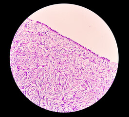 Histology, Peritoneal inclusion cyst. Paraovarian cysts, hydrosalpinx and low-grade cystic mesothelioma are usually considered in the differential diagnosis of PICs.