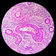Histology, Peritoneal inclusion cyst. Paraovarian cysts, hydrosalpinx and low-grade cystic...