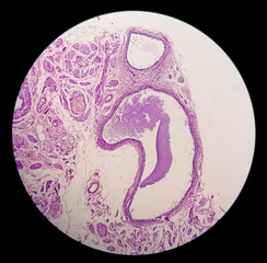 Histology, Peritoneal inclusion cyst. Paraovarian cysts, hydrosalpinx and low-grade cystic...