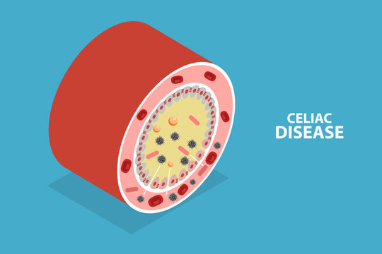 3D Isometric Flat Vector Illustration of Celiac Disease, Gluten Intolerance