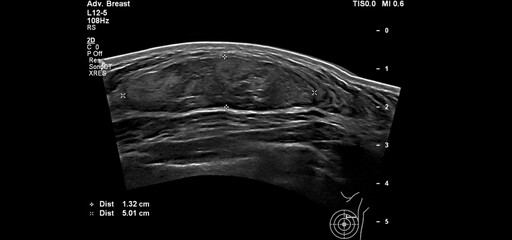Image of breast ultrasound for cancer checks in women with breast mass.A female with a breast lump...