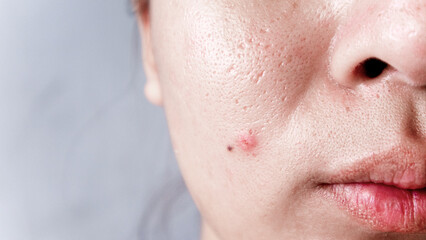 Asian face, Macro skin with enlarged pores. Allergic reaction, peeling, care for problem skin.