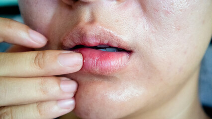 Dry, chapped, peeling lips :dry skin problem with mouth disease - obrazy, fototapety, plakaty