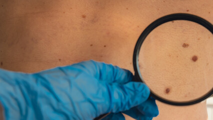 Mole dermoscopy, preventive of melanoma. Dermatologist examining patient's birthmark with...