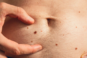 Fototapeta premium Male hand showing birthmarks on skin body stomach part. Close up detail of the bare skin. Health Effects of UV Radiation. Man with birthmarks Pigmentation and lot of birthmarks