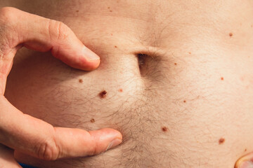 Male hand showing birthmarks on skin body stomach part. Close up detail of the bare skin. Health Effects of UV Radiation. Man with birthmarks Pigmentation and lot of birthmarks