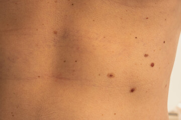 Male showing birthmarks on skin body stomach part. Close up detail of the bare skin. Health Effects...